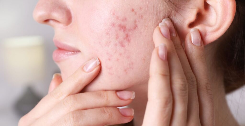 Pimples