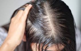 Hair Fall Problem